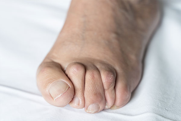 Advanced Podiatry | Ingrown Nails, Diabetic Foot Care and Orthotics
